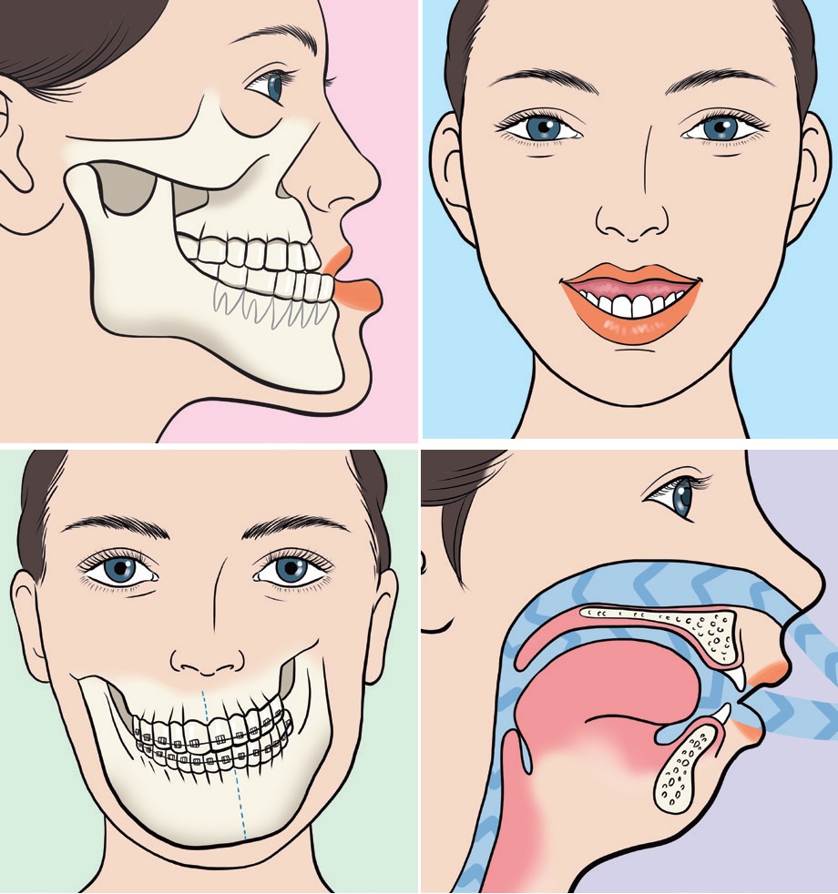 What Is Orthognathic Surgery 